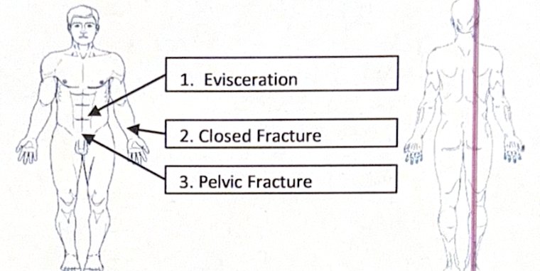 Test Scenario 1 injury diagram
